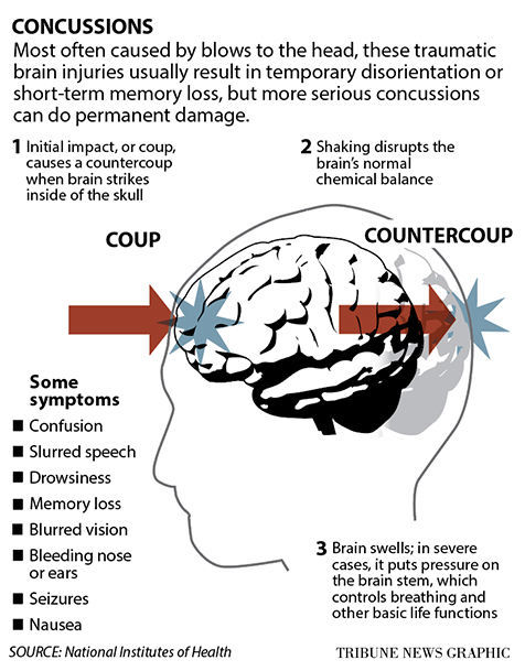 Concussion explainer graphic